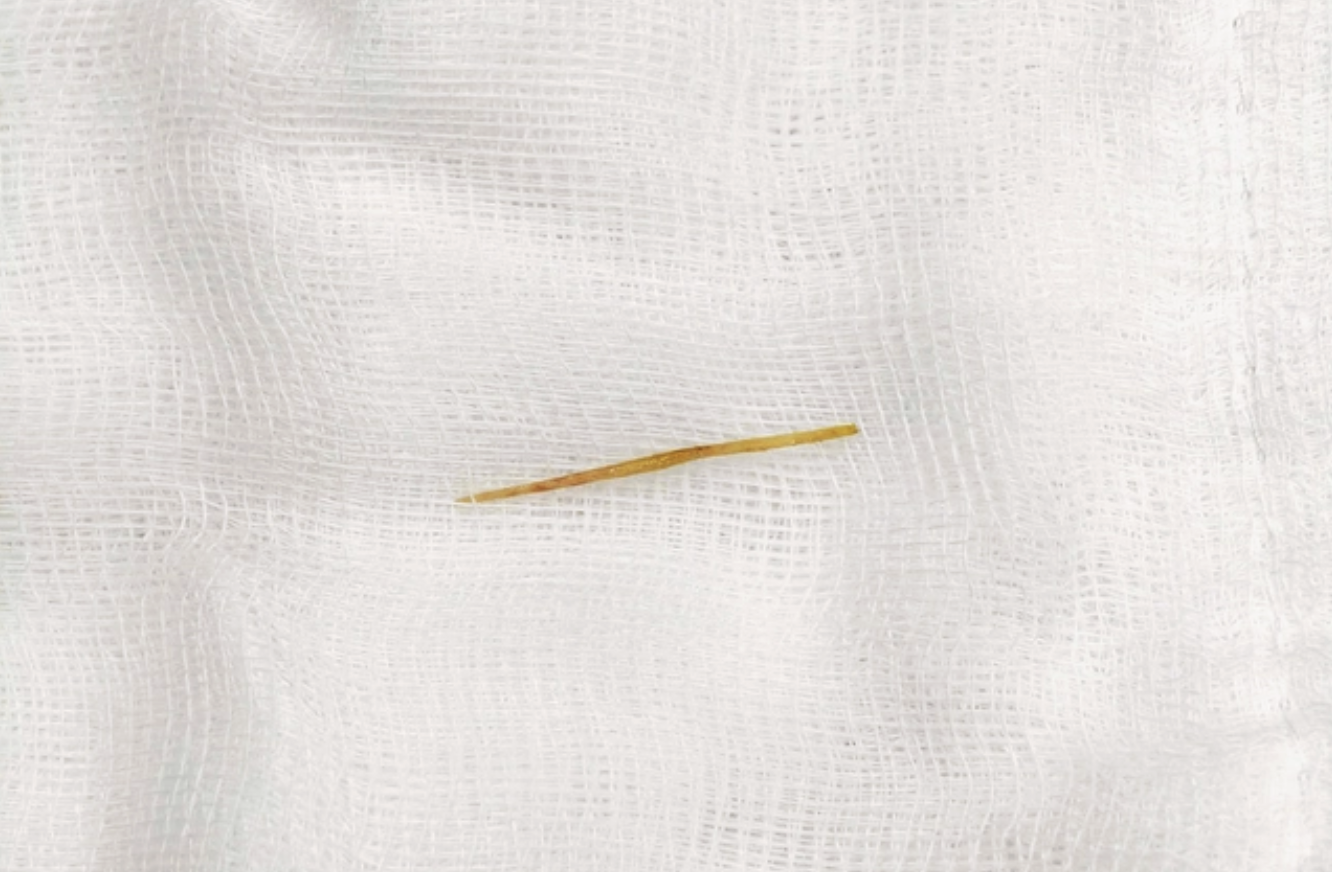 Nuốt nhầm tăm tre: Thói quen nhỏ, nguy cơ thủng ruột đe dọa tính mạng